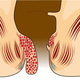 Illustration for article titled Nama Obat Benjolan Wasir Stadium 4